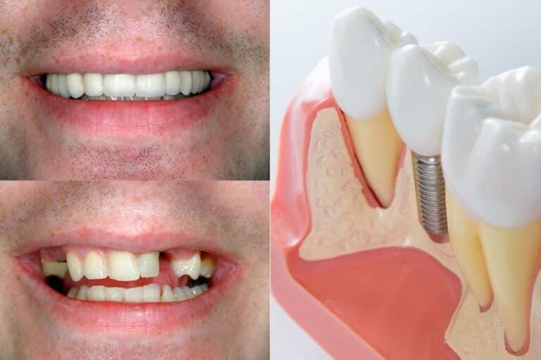 implant-dentaire-avant-apres