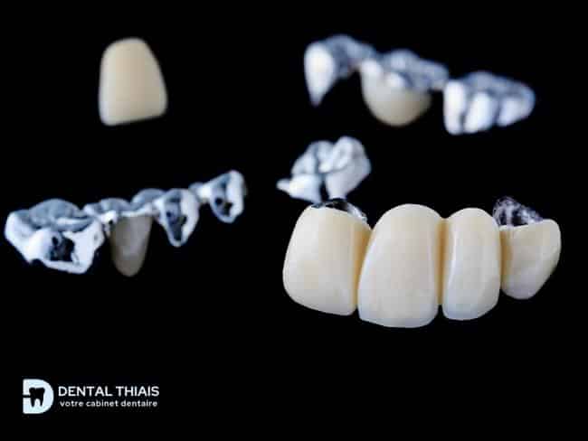 Pourquoi un bridge dentaire ?  Cabinet Dentaire Castellane 13006.