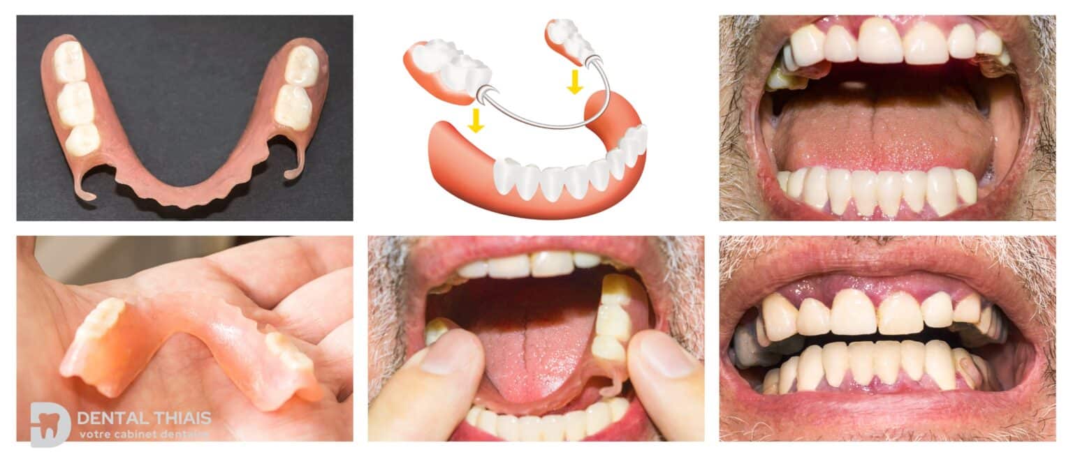prothese-dentaire-avant-apres-etude-cas