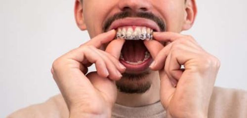 patient-invisalign